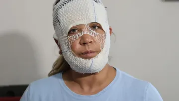 Konya’da Estetik İşlem Sonrası Kabus: Yüzünde Yanıklar Oluştu