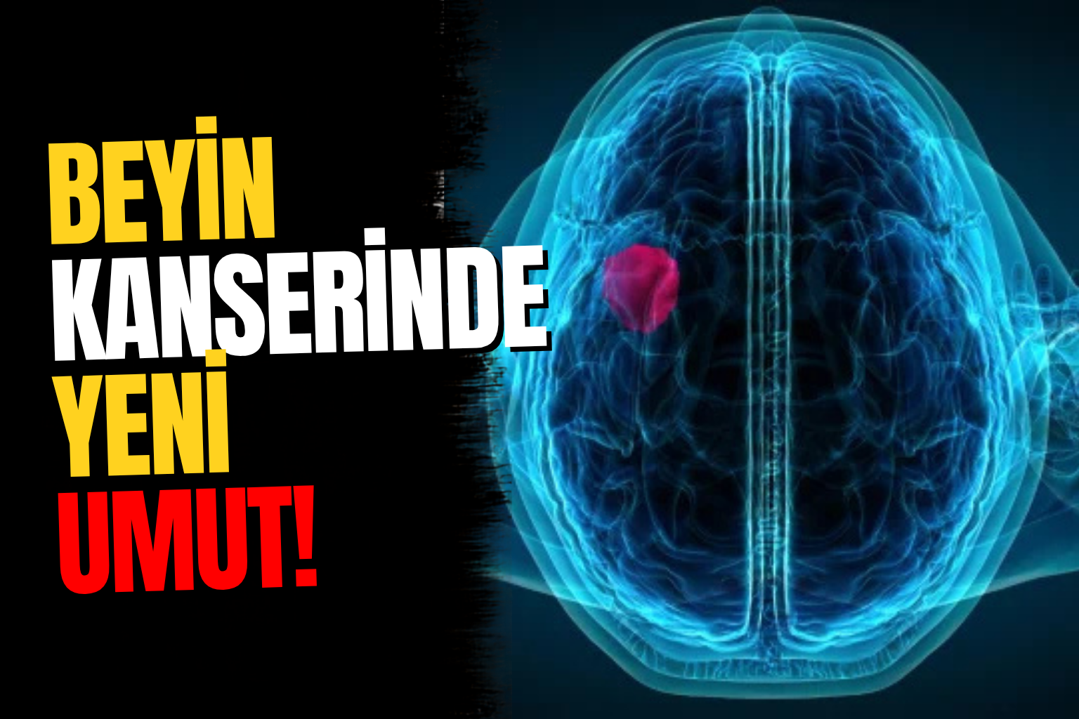 Beyin Kanseri Tedavisinde Yeni Umut