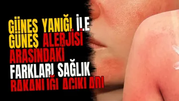 Güneş yanığı ile güneş alerjisi arasındaki farkları Sağlık Bakanlığı açıkladı